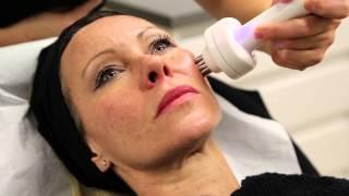 Radiofrequency Skin Tightening Lift-Shape