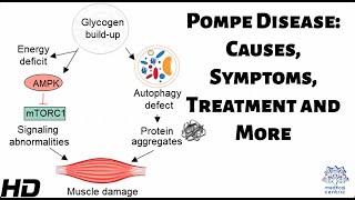 Pompe Disease: Causes, Symptoms, Treatment and More