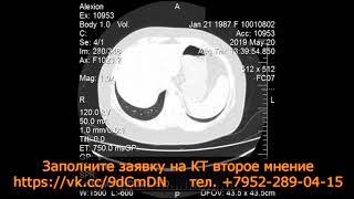 ПРАВОСТОРОННЯЯ ПНЕВМОНИЯ с симптомами матового стекла на расшифровке МСКТ грудной клетки онлайн