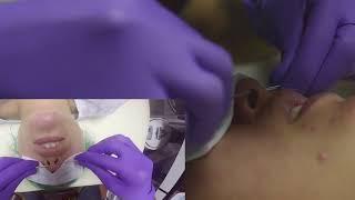 Septum PROCEDURE VIDEO- piercing by Ruben Lew