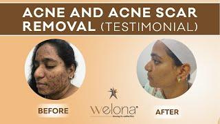 Acne Scar & Acne Removal Treatment Chennai | Amazing Results | Clear Skin (முகப்பரு நீங்க)