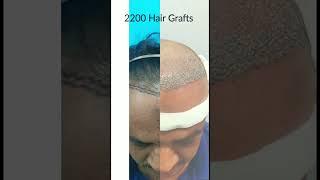 Hair Transplant in Mumbai   ( +91 9222222407 )