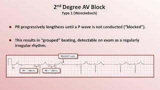 Intro to EKG Interpretation - AV Block