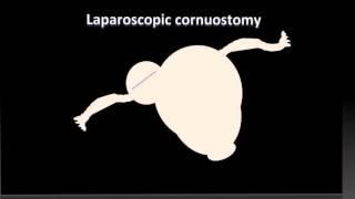 Interstitial ectopic laparoscopic resection final video