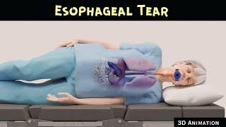 Esophageal Tear | 3D Animation