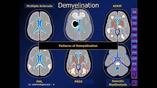 ️ Making Sense of White Matter Disease by James G. Smirniotopoulos, M.D.