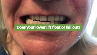 Suction Dentures - You won't believe the difference!