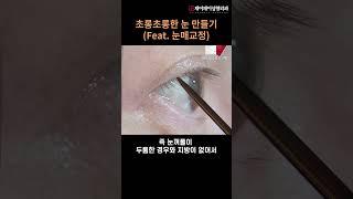 초롱초롱한 눈 만들기(feat.눈매교정) - 제이제이성형외과#shorts