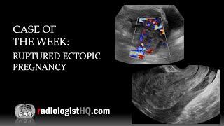 Case of the Week: Ruptured Ectopic Pregnancy (Ultrasound)