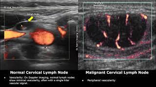 Cervical Lymph Nodes Ultrasound Normal Vs Abnormal Images | Reactive & Malignant Neck Nodes USG Scan