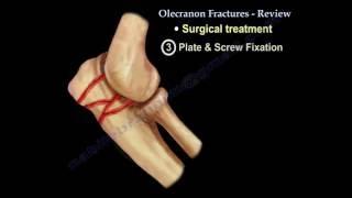 Olecranon Fractures- Everything You Need To Know - Dr. Nabil Ebraheim