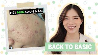 HẾT MỤN SAU 6 NĂM - Mụn Viêm, Mụn Ẩn, Sẹo Lõm️#Back2Basic