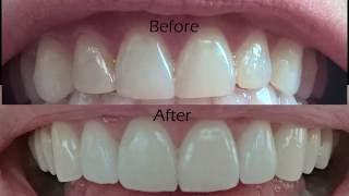 Dental Veneers Procedure Overview