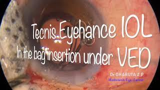 Topical Phacoemulsification on Centurian Vision System with Active Sentry