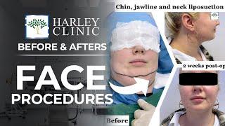 Our Face Procedure Before & Afters - Face, Neck & Eyebrow Lifts | Harley Clinic Group