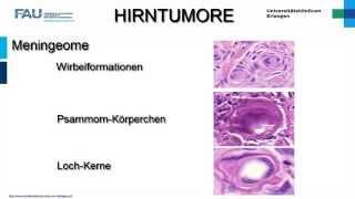 Neuropathologie ─ Hirntumoren