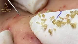 Getting blackheads is great (310_1) | Loan Nguyen