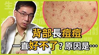 為什麼背部長痘痘，會一直治不好？怎麼治療才不會色素沉澱？治療背部痘痘的關鍵原因，醫美里長一次告訴你！