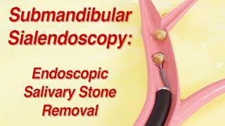 Submandibular Sialendoscopy: Endoscopic Salivary Stone Removal