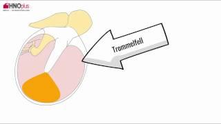 Trommelfellschnitt Paukenröhrchen OP