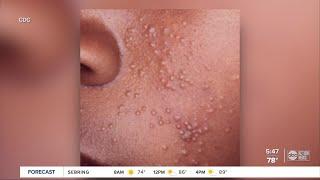 Local pediatrician advises parents on treating molluscum, viral skin infection common with kids