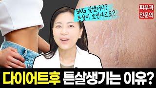 힘들게 살뺐더니 왠 튼살? 3kg이상 뺄 생각있는분들 꼭 보세요! 다이어트 후 튼살예방 자가관리법!