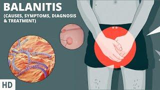 The Secrets to Breaking Free from Balanitis: Your Complete Guide to Understanding and Treatment!