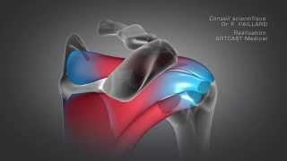 Arthroscopie de l'épaule : Réparation de la coiffe