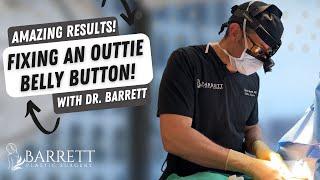 Turning An Outie Belly Button Into An Innie! | Barrett Plastic Surgery