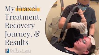 My #Fraxel Journey: Treatment, Recovery Diary, & Results