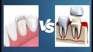 Veneers vs Crowns - Whats the Difference?