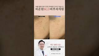 [압구정허준원엠디피부과] 색소치료 4개월차후기 #기미치료 확실하게 치료하세요!!