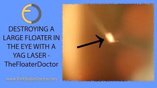 YAG Laser Treatment of a Dense Vitreous Eye Floater. The Floater Doctor