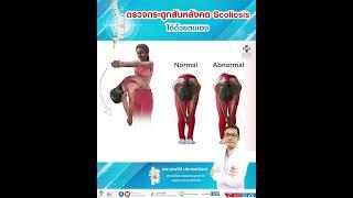 วิธีตรวจกระดูกสันหลังคด | Scoliosis