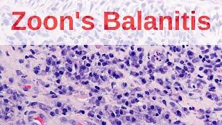 Zoon's Balanitis - Pathology mini tutorial