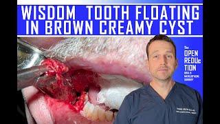 WISDOM TOOTH in BROWN CREAMY CYST