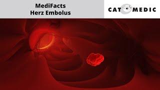 MediFacts - Herz Embolus