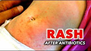 RASH AFTER ANTIBIOTICS!!! (Is this an Allergic Reaction?) | Dr