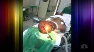 Steel rod pierces mans head, man survives.