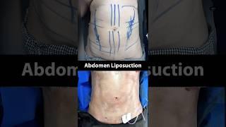 Abdomen Liposuction Before and After! On Table Result 2024 #shortsfeed