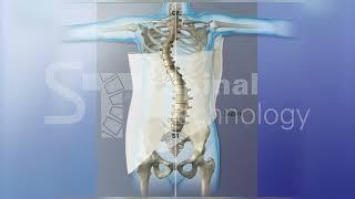 A Scoliosis Double Curve- Providence Nocturnal Scoliosis® Orthosis