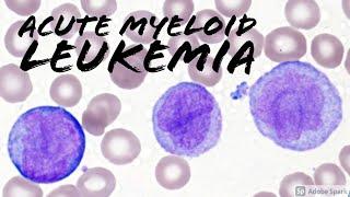 Acute Myeloid Leukemia (AML) w/ Monocytic Differentiation (formerly AMML) with Blasts & Promonocytes