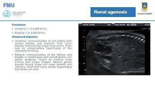 Urinary tract abnormalities and amniotic fluid abnormalities.