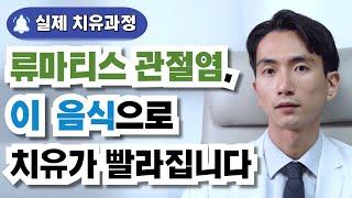 류마티스 관절염 치료법과 류마티스 관절염 증상부터 류마티스 관절염 좋은 음식까지