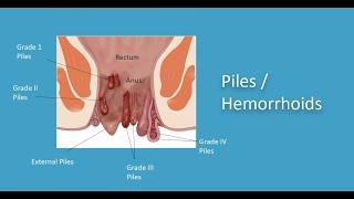 Piles Treatment : Dr. Ramakant Sharma.