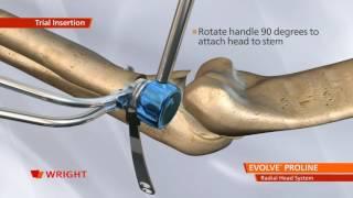 EVOLVE™ PROLINE Radial Head System Animation