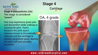 Osteoarthritis - An Introduction | Joint Pain Causes | Stages Of Osteoarthritis of the knee India