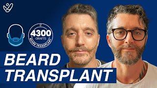 Beard Transplant Journey: 4300 Graft Before And After | Up To 18 Months