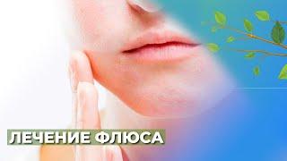 Флюс.Периостит челюсти️