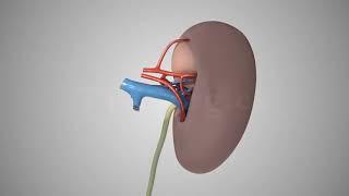 Living donor kidney transplant: Laparoscopic left nephrectomy